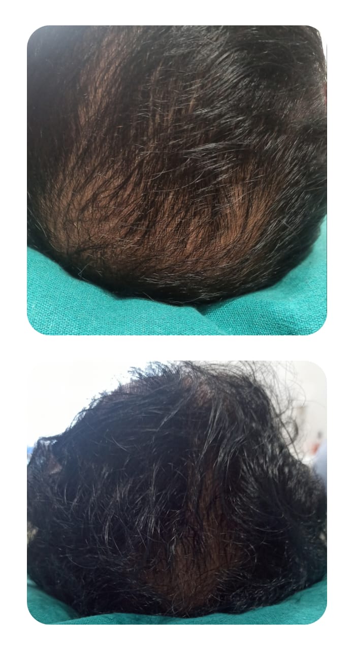 Hair Restoration
