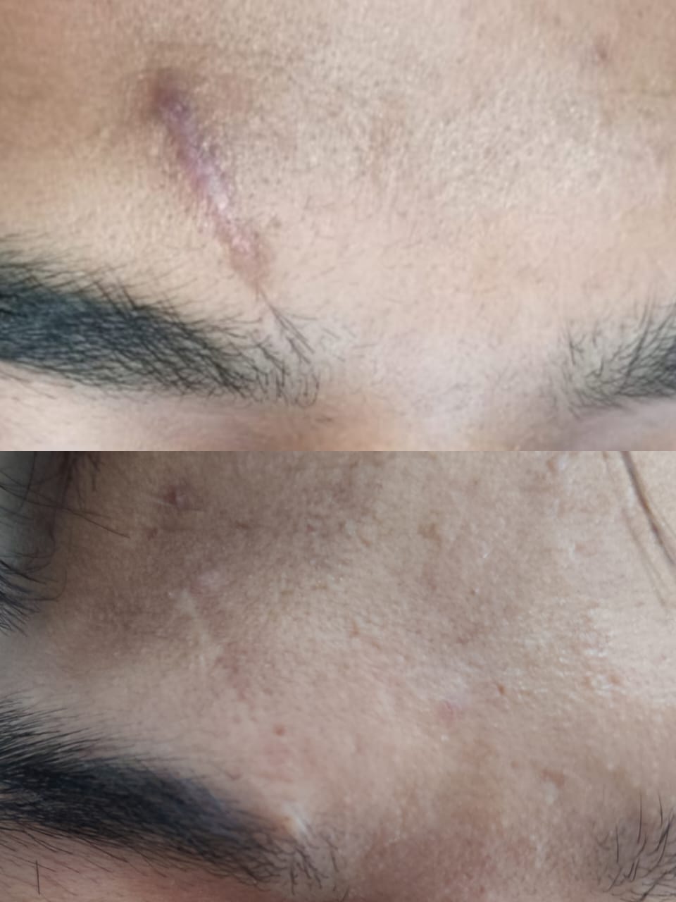 Laser Hair Removal