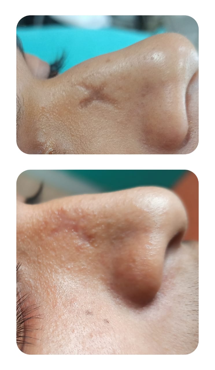 Nose Scar Revision