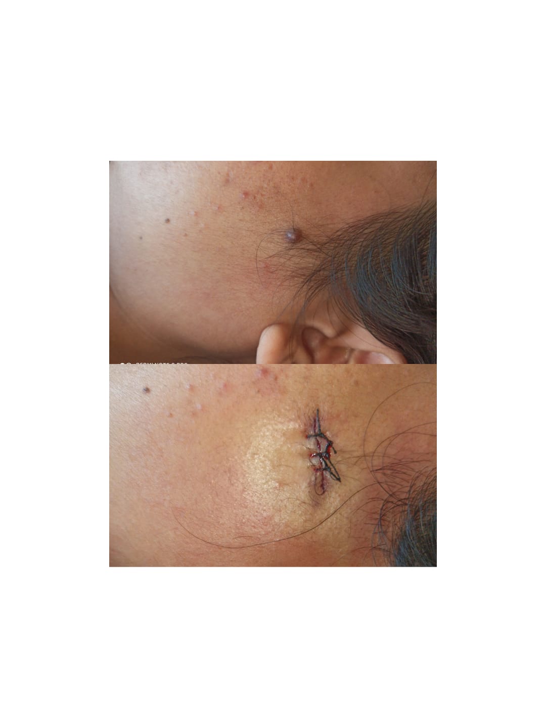 Mole Removal
