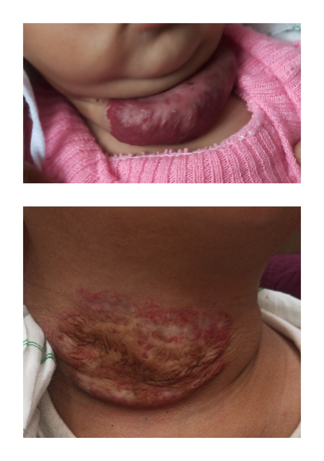 Vascular Lesion Treatment