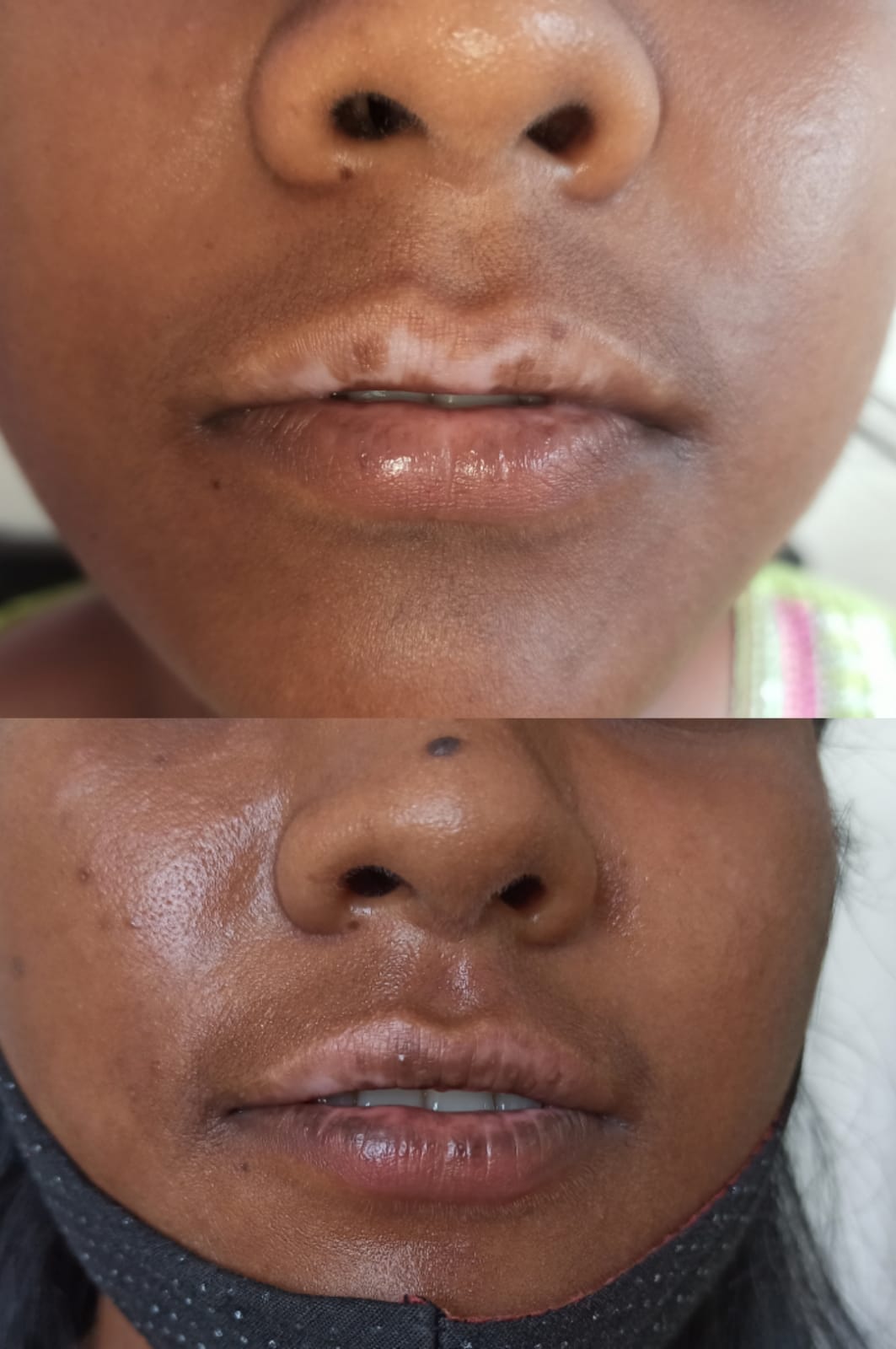 Vitiligo Lip Grafting