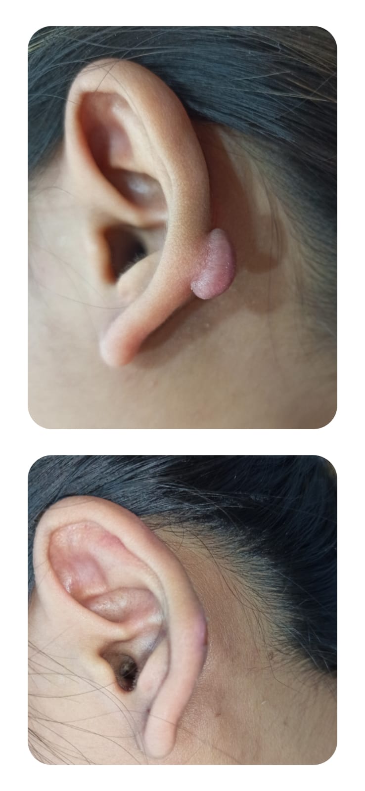 Earlobe Keloid Removal