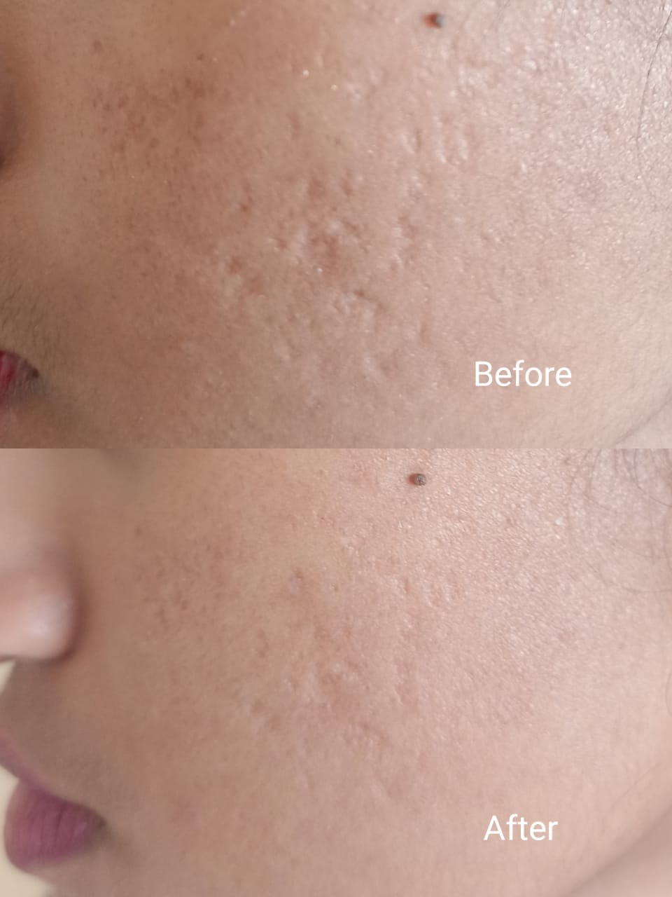 Acne Scar Treatment