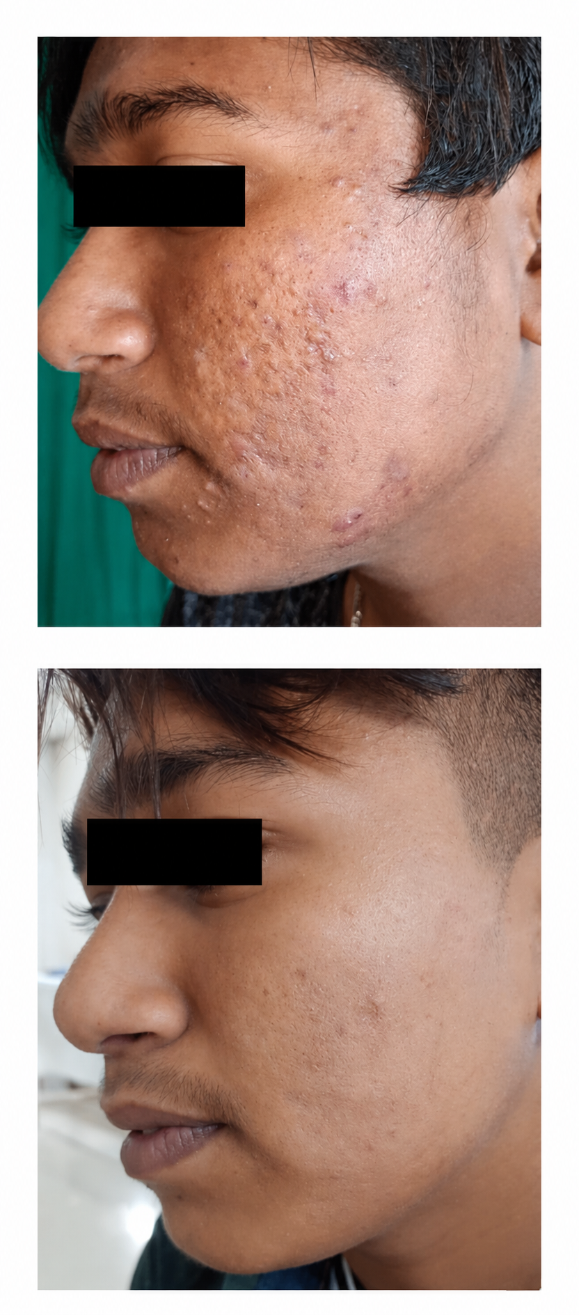 Active Acne & Scar Treatment