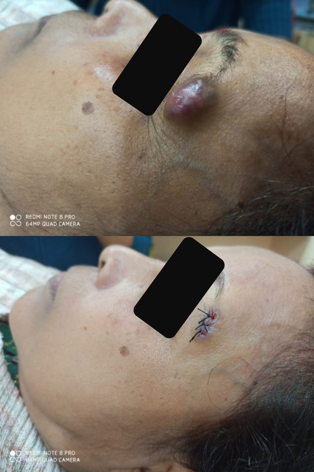 Brow Cyst Excision
